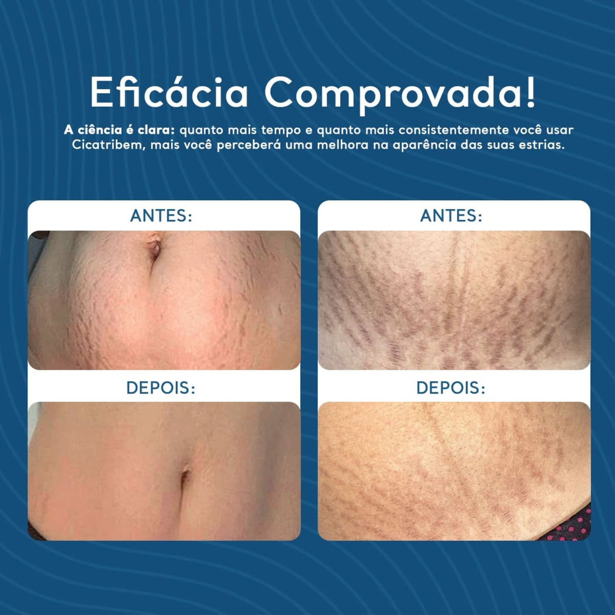 Creme Antiestrias Regenerador Dérmico COMPRE 1 E LEVE 3