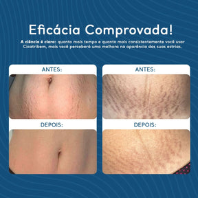 Creme Antiestrias Regenerador Dérmico COMPRE 1 E LEVE 3
